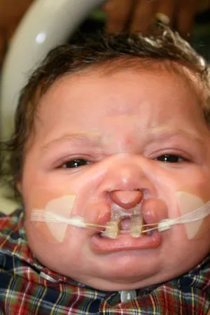 Before - Facial prosthetics