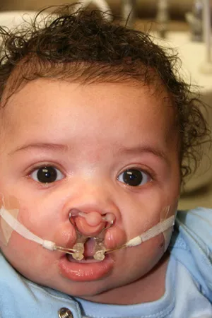 Before - Facial prosthetics for baby