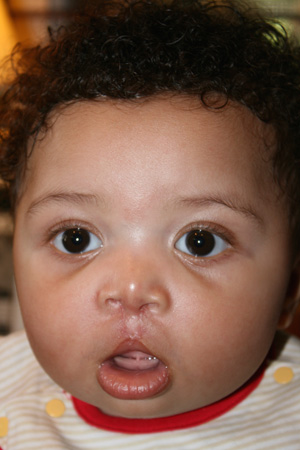 After - Facial prosthetics for baby