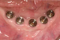 Implant in mouth without teeth