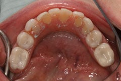 Implant in mouth with teeth