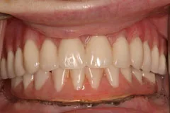 Implant - results