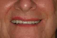 Before - Partial Denture Case