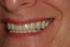 After - Partial Denture Case