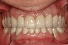 After - Partial Denture Case