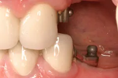 Partial Denture Case
