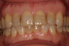 Before - Porcelain Veneer Case