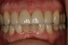 After - Porcelain Veneer Case
