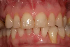 Before - Porcelain Veneer Case