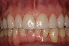 After - Porcelain Veneer Case