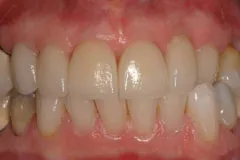After - Porcelain Veneer Case