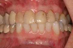 Before - Porcelain Veneer Case