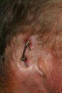 Before - Prosthetic Ear