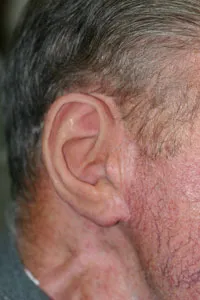 After - Prosthetic Ear