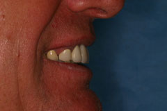 Before - Replacement Bridge Case