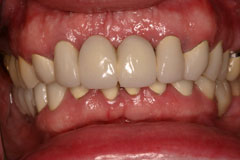 Before - Replacement Bridge Case