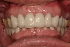 After - Replacement Bridge Case