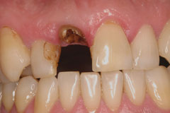 Missing tooth