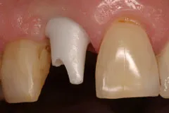Single Dental Implant