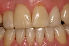 Single Dental Implant - result