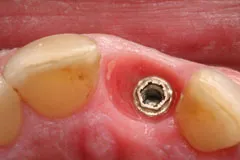 Single Dental Implant