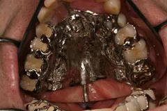 Speech Aid Appliance - inside mouth