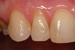 Before - Veneers Case Study