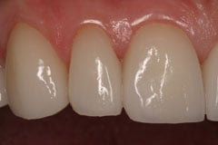 After - Veneers Case Study