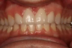 After - Porcelain Veneer Case