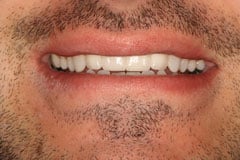 After - Porcelain Veneer Case
