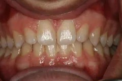 Before - Porcelain Veneer Case