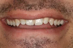 Before - Porcelain Veneer Case